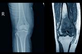 X-ray and MRI of knee join showing soft tissue mass and malignant bone tumor