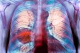 Lung cancer: 'artificial nose' detected 96% of cases (Du Cane Medical Imaging Ltd/Science Photo Library)