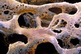 Osteoporosis: GPs want better access to screening services (photo: Science Photo Library)