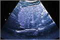 Ultrasound of a fatty liver