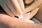 Biopsy procedure: the RCGP wants to prove the value of GP minor surgery (Photo: SPL)