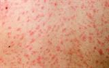 Measles rash is erythematous and maculopapular