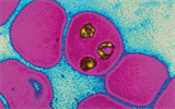 Malaria film showing P falciparum, the most virulent form