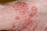 Moderate to severe psoriasis is linked to a greater risk of CKD (Photo: iStock)