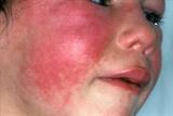 Scarlet fever: levels higher than last year (Photo: Science Photo Library)