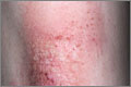 Steroid plus emollient: an effective treatment for recurrent dermatitis