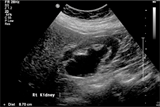 Renal ultrasound showing hydronephrosis (patient had mid-ureteric stone)