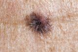 Melanoma: GPs face rise in legal challenges (Photo: iStock)