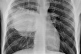 Lung cancer: three-quarters of cases present at a late stage (Photo: SPL)