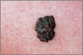 Skin cancer