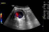 Men over 65 are eligible for ultrasound screening for abdominal aortic aneurysm (AAA) (Photo: Science Photo Library)