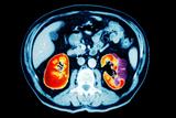 Kidney cancer rates are increasing (Photo: SPL)