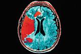 Stroke risk increases sharply with only a small rise in BP (photo: Zephyr/SPL)