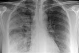 X-ray of pneumonia: GPs are urged to refer high-risk cases (photo: SPL)