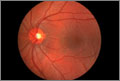 Retina Posterior Pole