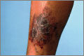 Venous insufficiency