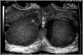 Transvaginal ultrasound