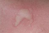 Urticaria