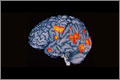 PET scan showing the areas of the brain active during hallucination