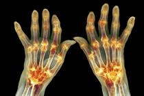 QOF Prevalence Check: Musculoskeletal domains