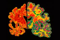 NICE amends Alzheimer's guidance