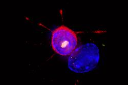 Huntington's treatment hope after trial success