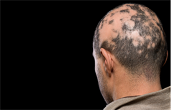 Back of man's head suffering from alopecia