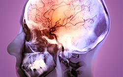 Anticoagulants linked to increased risk of stroke and haemorrhage in CKD patients