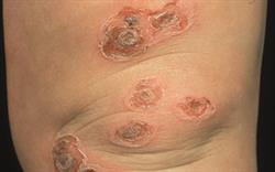Update on dermatological signs of child abuse with a free interactive learning module from intelog Learning