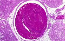 NICE approves apixaban for treatment of DVT and pulmonary embolism
