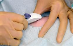 New insertion site for Nexplanon following safety concerns
