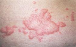 Xolair (omalizumab) A New Treatment For Chronic Spontaneous Urticaria