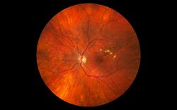 NICE recommends two treatments for diabetic macular oedema