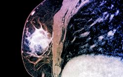 Palbociclib provides new option in breast cancer