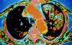 Triple therapy 'potentially best option' for stable COPD patients