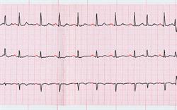 Print-out of an electrocardiogram (ECG) showing paroxsyms of atrial fibrillation.