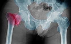 X-ray image of a hip fracture