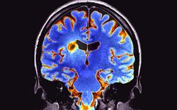 NICE approves more treatments for MS