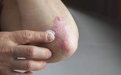 Close-up of a person's fingers applying a white cream to a red, scaly, raised patch of psoriasis on their elbow.