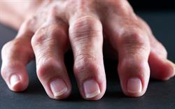 Arthritis biologic approved for NHS prescribing