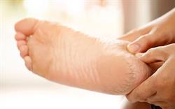 Sole of a foot with dry cracked skin on the heel.