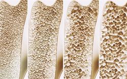 New vitamin D deficiency thresholds recommended