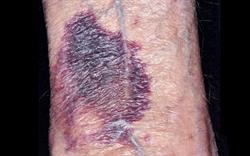 Warfarin interaction warning for miconazole oral gel