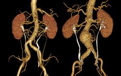 Quinolone warning over aortic aneurysm risk