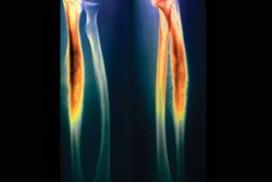 Ewing’s sarcoma (orange) is a rare type of bone and soft tissue cancer more common among teenagers