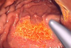 Long-term PPI use associated with hypomagnesaemia and fractures