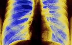 New salmeterol/fluticasone MDI extends choice in asthma prescribing