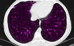 Inhaled levofloxacin offers new option for treatment of infection in cystic fibrosis