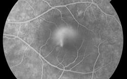 Warn patients to report visual disturbances during steroid treatment, GPs advised