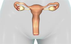 Olaparib: new treatment option for ovarian cancer